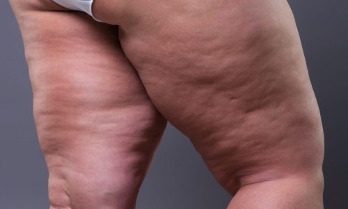 Fat,Female,Body,With,Cellulite,,Overweight,Hips,And,Legs,On Fat,Female,Body,With,Cellulite,,Overweight,Hips,And,Legs,On