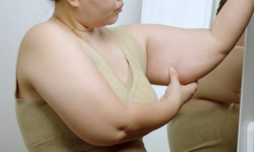 Asian,Oversize,Woman,Squeezing,Excess,Flabby,Fat,Of,Arm,In Asian,Oversize,Woman,Squeezing,Excess,Flabby,Fat,Of,Arm,In